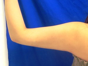 上腕　術後３ヶ月